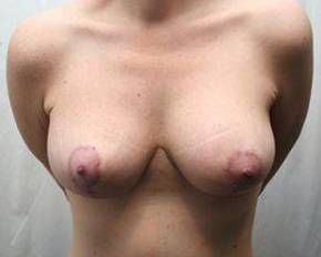 after breast lift with augmentation front view case 3683