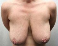 before breast lift with augmentation front view case 3683