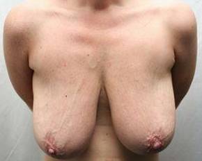 before breast lift with augmentation front view case 3683