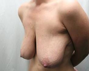 before breast lift with augmentation left angled view case 3683