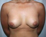 after breast lift with augmentation front view case 3690