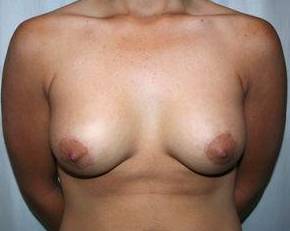 after breast lift with augmentation front view case 3690