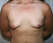 before breast lift with augmentation front view case 3690