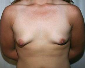 before breast lift with augmentation front view case 3690