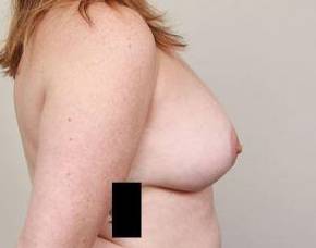 after breast lift with augmentation right side view case 3695