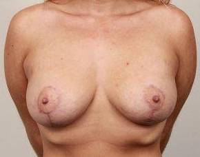 after breast lift with augmentation front view case 3707
