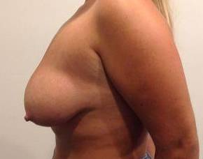 before breast lift with augmentation left side view case 3707