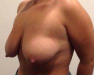before breast lift with augmentation left diagonal view case 3707