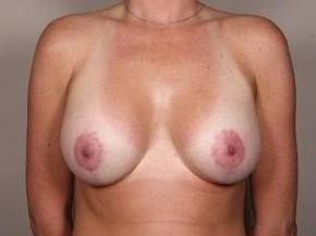 after breast lift with augmentation front view case 3714