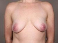 before breast lift with augmentation front view case 3714
