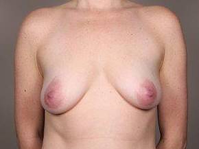 before breast lift with augmentation front view case 3714