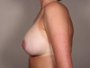 after breast lift with augmentation left side view case 3714