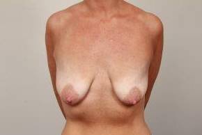before breast lift with augmentation front view case 3721