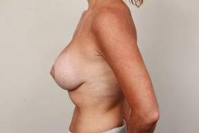 after breast lift with augmentation left side view case 3721