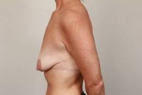 before breast lift with augmentation left side view case 3721