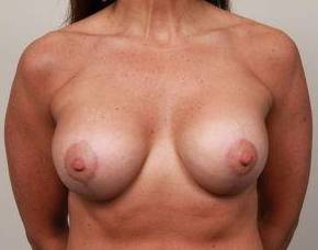 after breast lift with augmentation front view case 3728