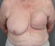 before breast reconstruction front view case 2513