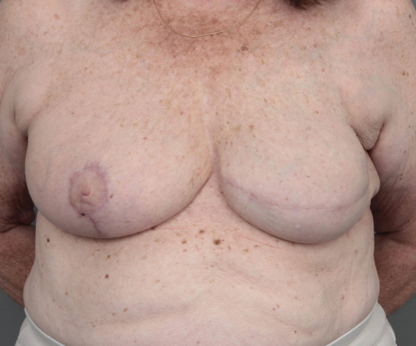 after breast reconstruction front view case 2513