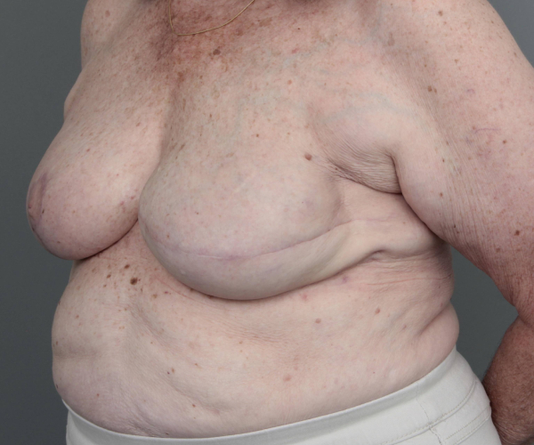 after breast reconstruction left angled view case 2513