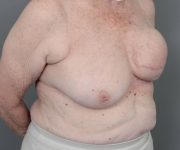 before breast reconstruction right angled view case 2513