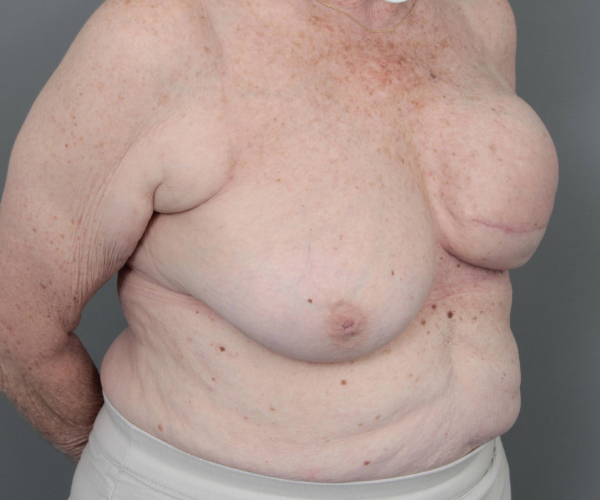 before breast reconstruction right angled view case 2513