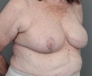 after breast reconstruction right angled view case 2513