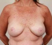 after breast reconstruction front view case 2535