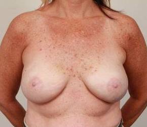 after breast reconstruction front view case 2535