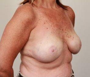 after breast reconstruction right angled view case 2535