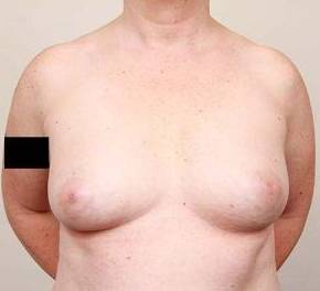 before breast reconstruction front view case 2542