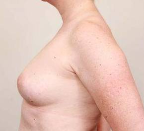 before breast reconstruction left side view case 2542