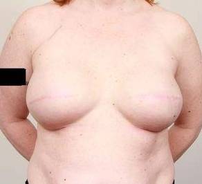 during breast reconstruction front view case 2542