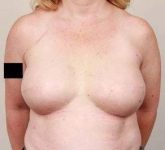 after breast reconstruction front view case 2542