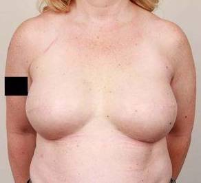 after breast reconstruction front view case 2542