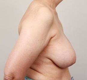 before breast reconstruction right side view case 2551