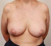 after breast reconstruction front view case 2551