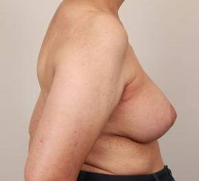 after breast reconstruction right side view case 2551