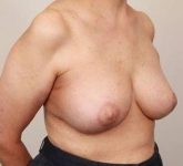 after breast reconstruction right angled view case 2551