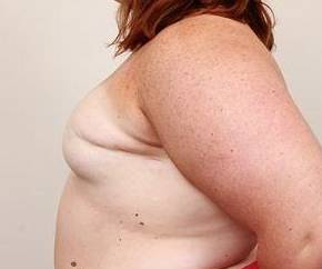 before breast reconstruction left side view case 2558