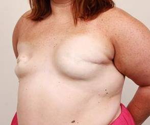 before breast reconstruction left angled view case 2558