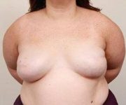 after breast reconstruction front view case 2558