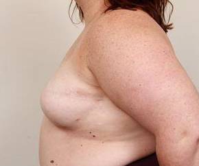 after breast reconstruction left side view case 2558