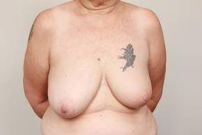 before breast reconstruction front view case 2565