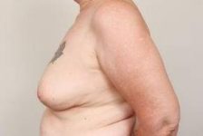 before breast reconstruction left side view case 2565