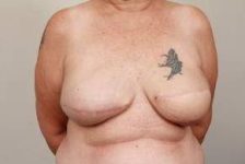 after breast reconstruction front view case 2565