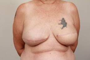 after breast reconstruction front view case 2565