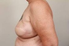 after breast reconstruction left side view case 2565