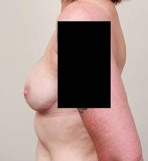 after breast reconstruction left side view case 2570