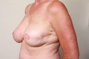 before breast reconstruction left angled view case 2575
