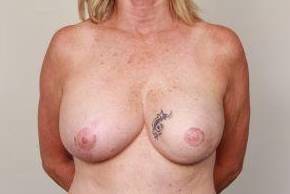 after breast reconstruction front view case 2575